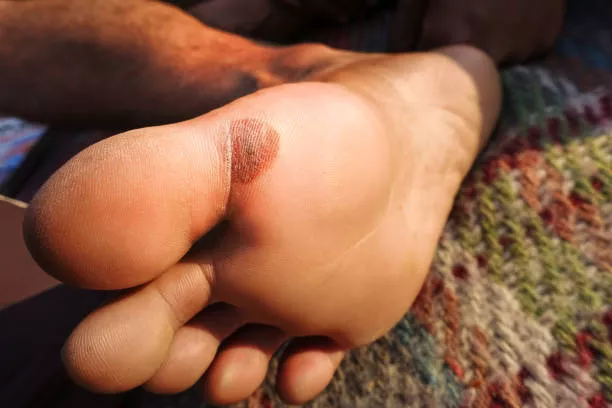 Detección Tardía De Melanoma En Pie