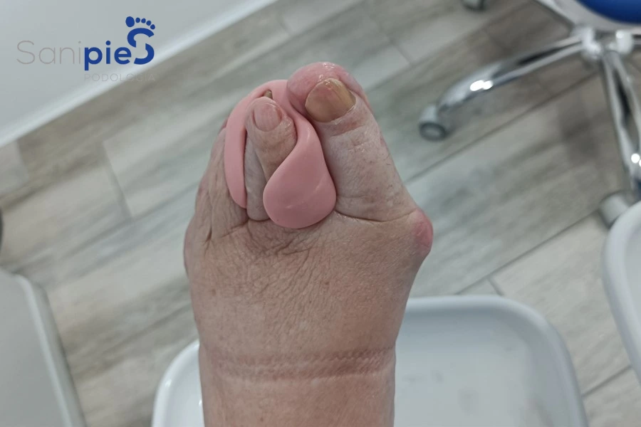 Ortesis de Silicona en dedos deformes