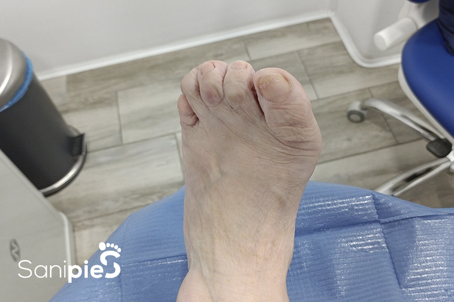 Artritis Reumatoide <br>en Adulto Mayor