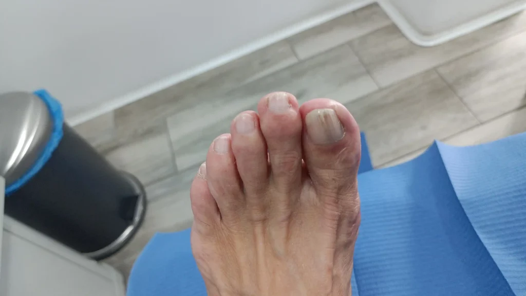 Img Terapias Podológicas para Artrosis en Pies Sanipies