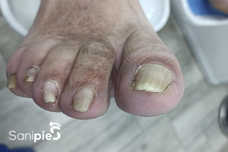 Matricectomía <br>Química Múltiple