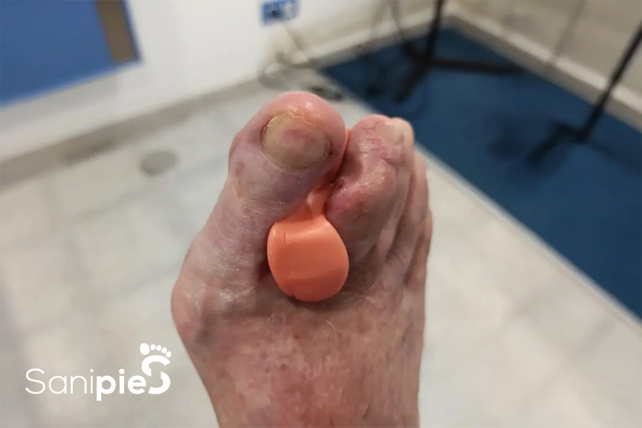 Órtesis de Silicona En <br>Paciente con Osteomielitis